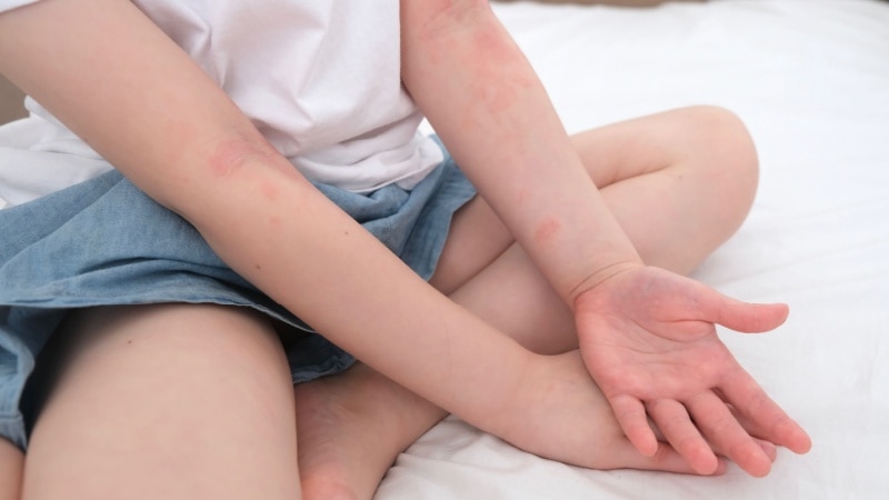 Penyebab anak alergi